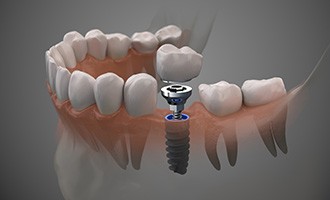 Up-close view of dental implant parts